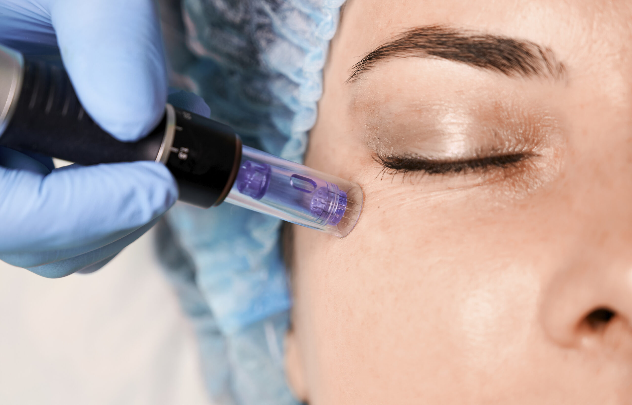 Facial con Microneedling