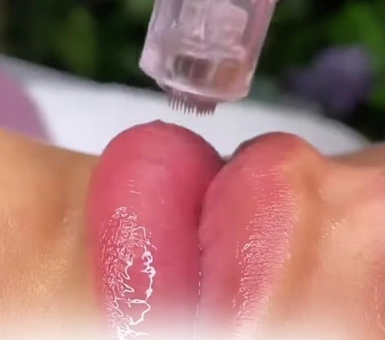Lip Hydration Microneedling